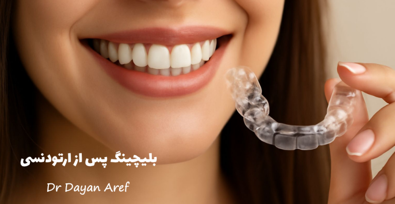 بلیچینگ پس از ارتودنسی: چرا باید فاصله زمانی رعایت شود؟