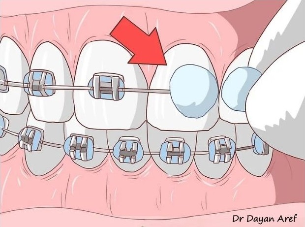 موم ارتودنسی یا ارتووکس