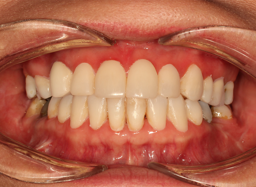 ارتوسرجری کلاس 3