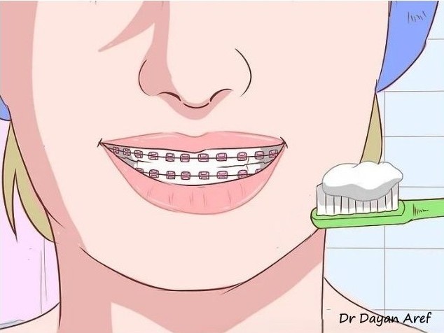 روش صحیح مسواک زدن هنگام درد بعد از ارتودنسی