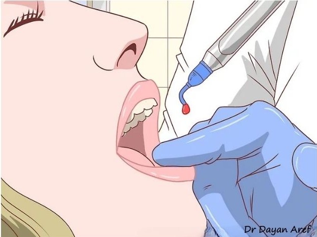 ژل بی حسی دهان